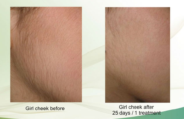 26+ Laser Hair Removal Wichita Ks Background