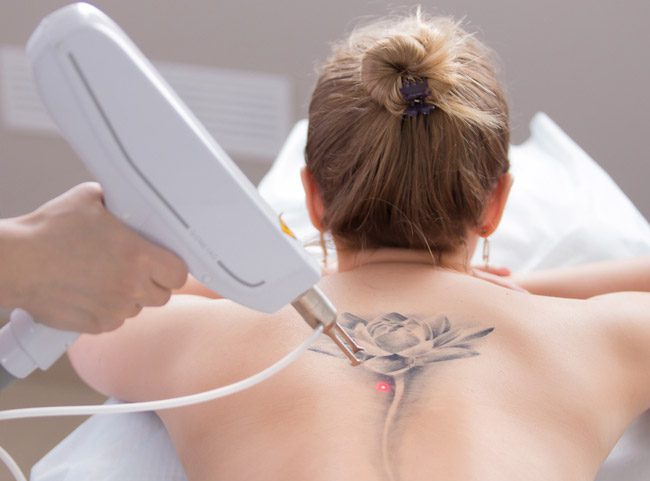 Laser Device removing tattoo from lady