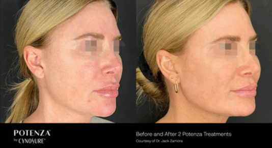 Potenza Before and After