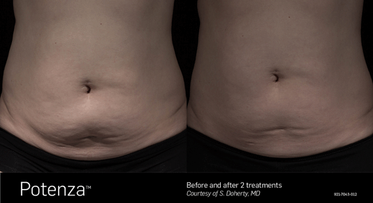 Potenza Before and After