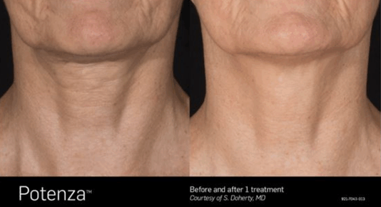 Potenza Before and After