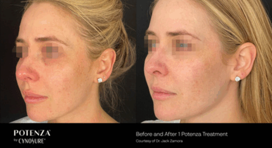 Potenza Before and After