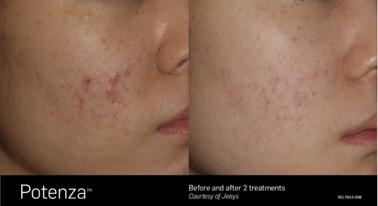 Potenza Before and After