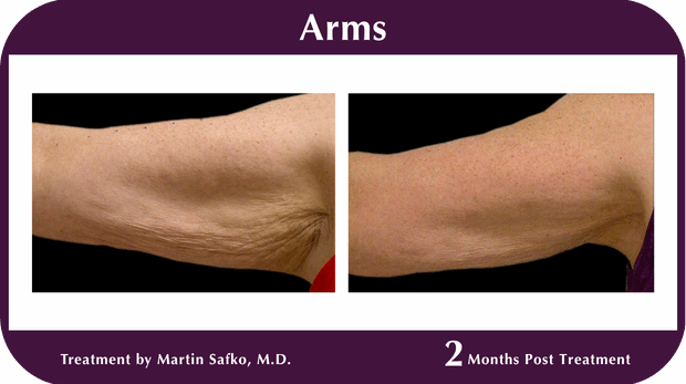 Thermage BA Arms