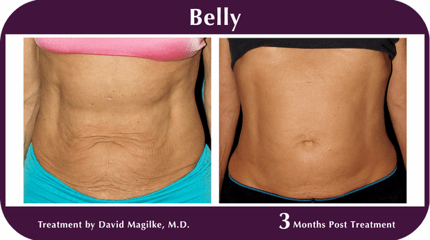Thermage BA Belly