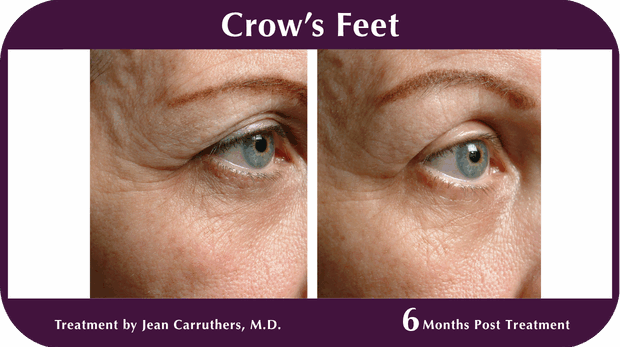 Thermage BA Crow's Feet