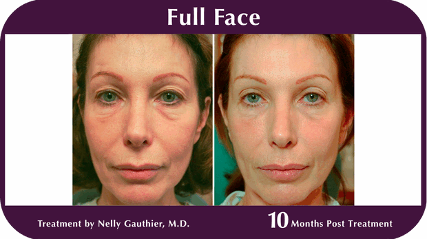Thermage BA Full Face
