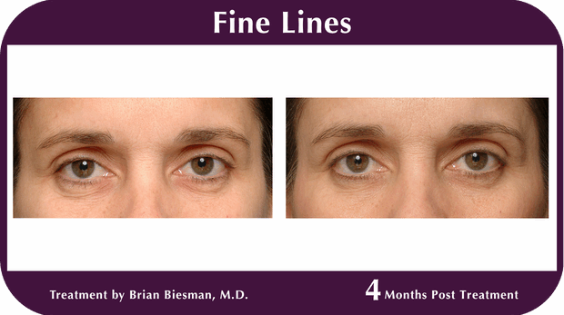 Thermage BA Fine Lines