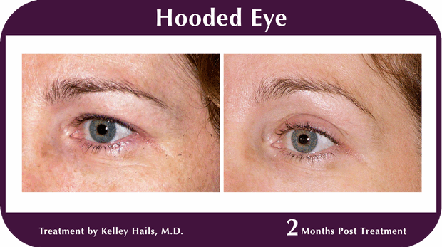 Thermage BA Hooded Eyes