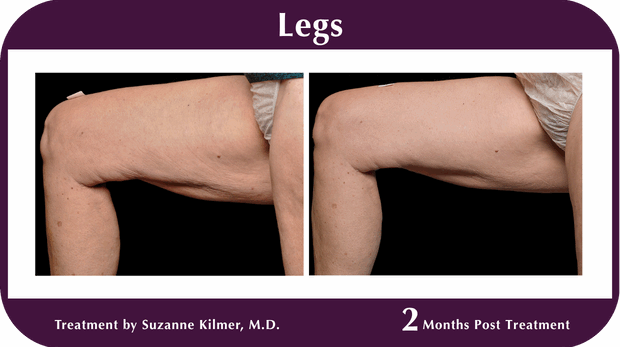 Thermage BA Legs