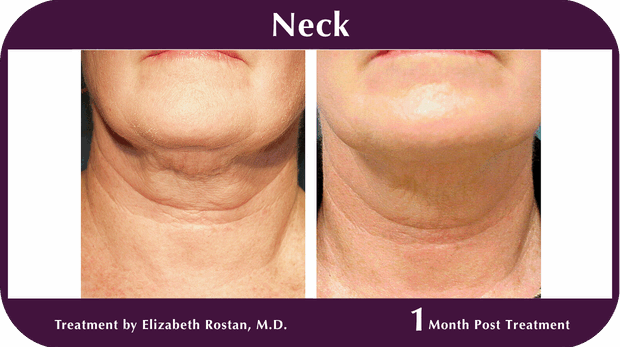Thermage BA Neck