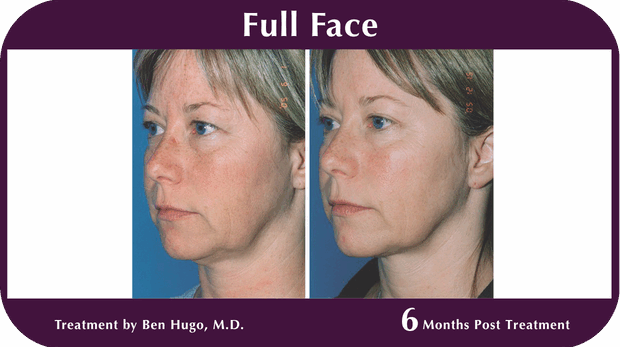 Thermage BA Full Face
