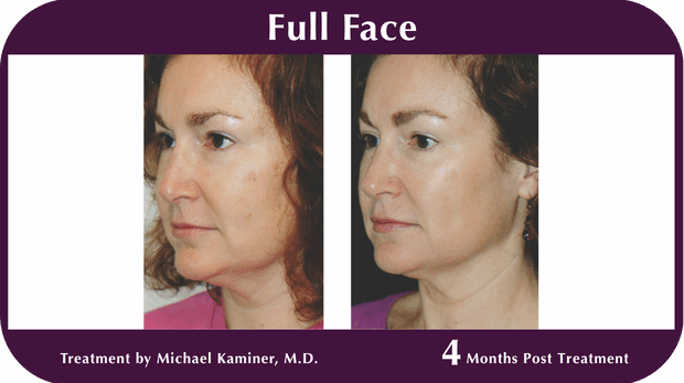 Thermage BA Full Face
