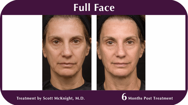 Thermage BA Full Face