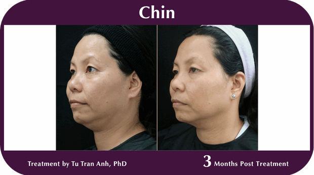 Thermage BA Chin