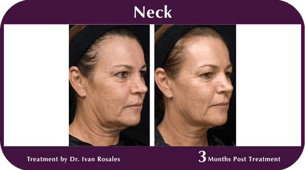 Thermage BA Neck
