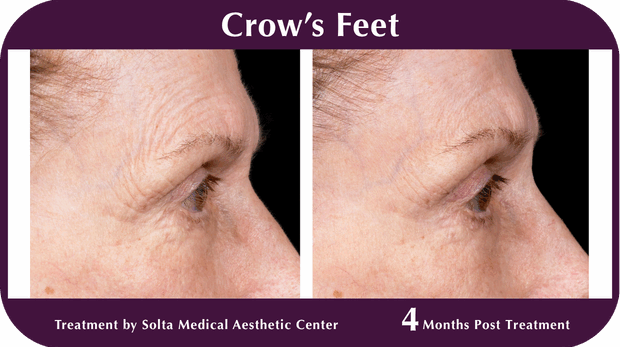 Thermage BA Crow's Feet