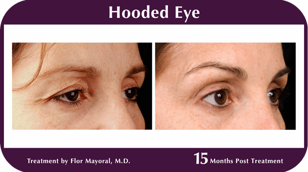 Thermage BA Hooded Eyes