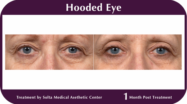 Thermage BA Hooded Eyes