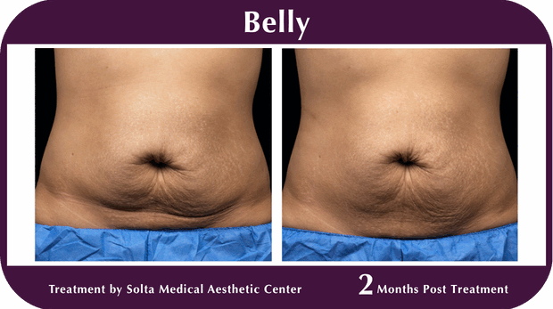 Thermage BA Belly