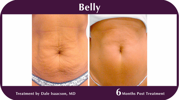 Thermage BA Belly