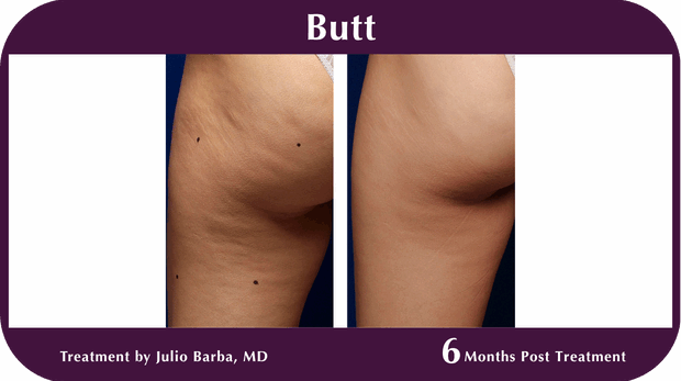Thermage BA Butt