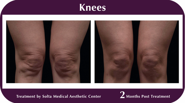 Thermage BA Knees