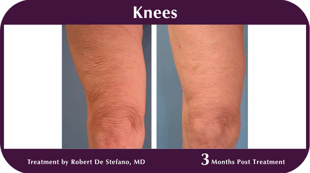 Thermage BA Knees