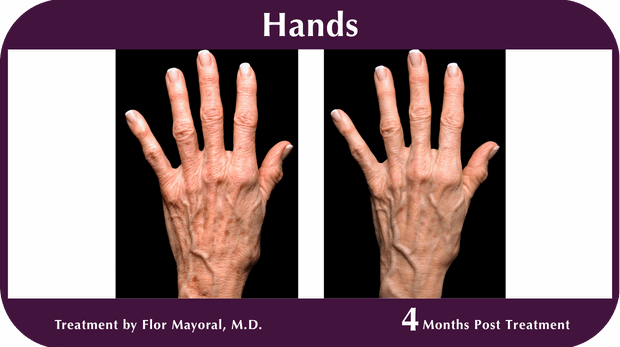 Thermage BA Hands
