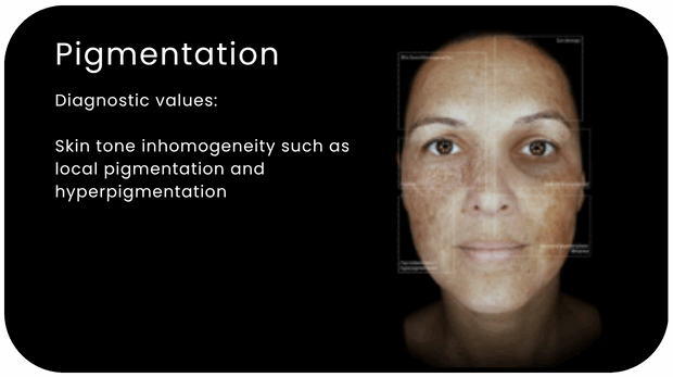 Alma IQ Pigmentation