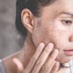 Hyperpigmentation (PIH)