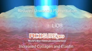 PicoSure Technology