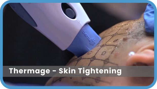 Thermage Thermage