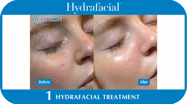 Hydrafacial BA