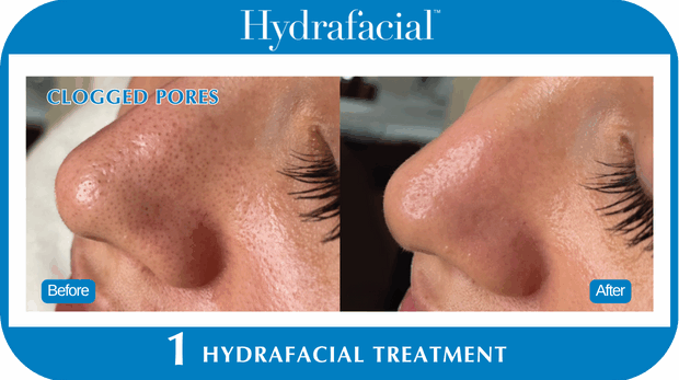 Hydrafacial BA