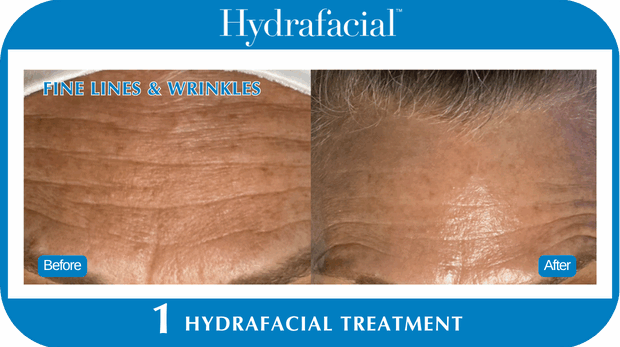 Hydrafacial BA