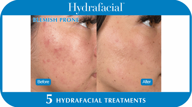 Hydrafacial BA