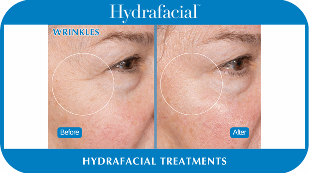Hydrafacial BA