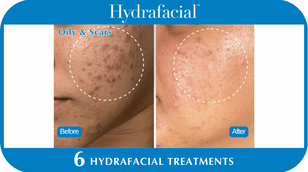 Hydrafacial BA
