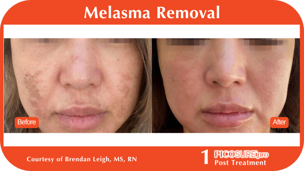 PicoSure Pro Before and After PicoSure Pro Before and After