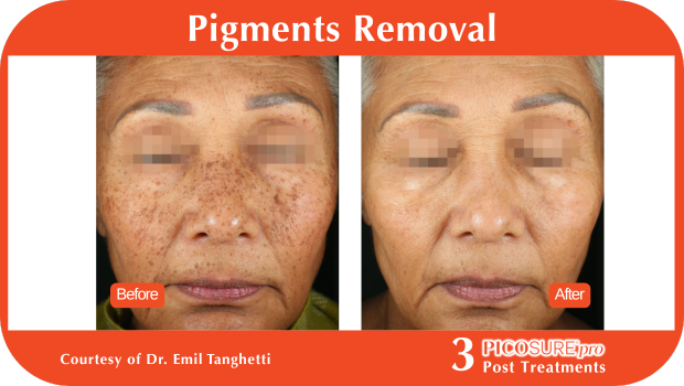 PicoSure Pro Before and After PicoSure Pro Before and After