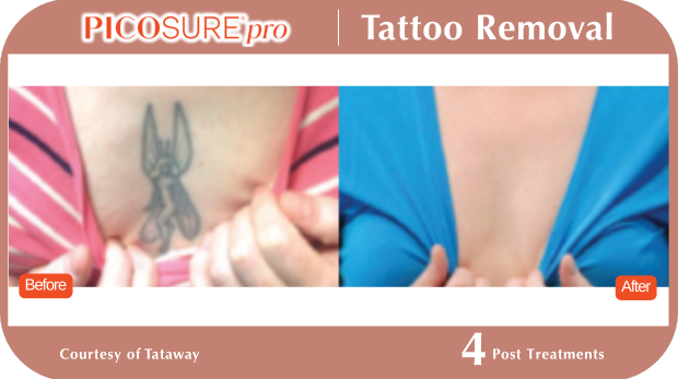 PicoSure Tattoo Removal PicoSure Tattoo Removal