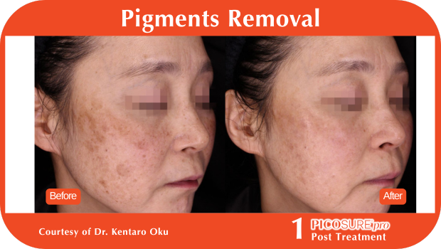 PicoSure Pro Before and After PicoSure Pro Before and After