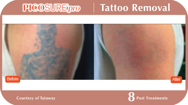 PicoSure Tattoo Removal PicoSure Tattoo Removal