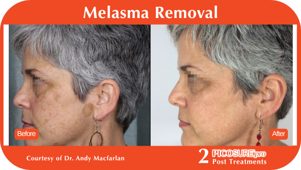 PicoSure Pro Before and After PicoSure Pro Before and After