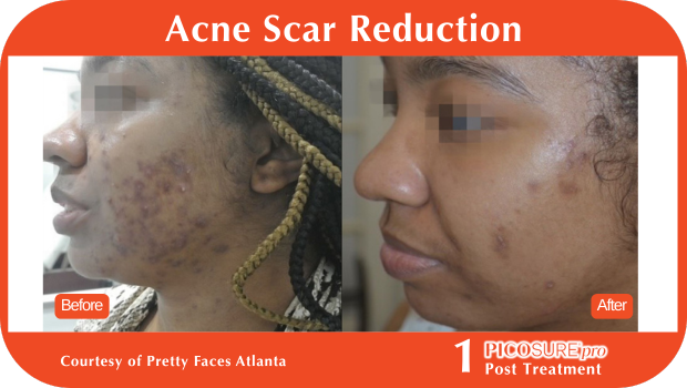 PicoSure Pro Before and After PicoSure Pro Before and After