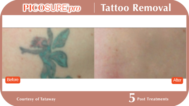 PicoSure Tattoo Removal PicoSure Tattoo Removal