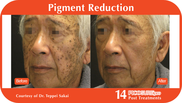 PicoSure Pro Before and After PicoSure Pro Before and After