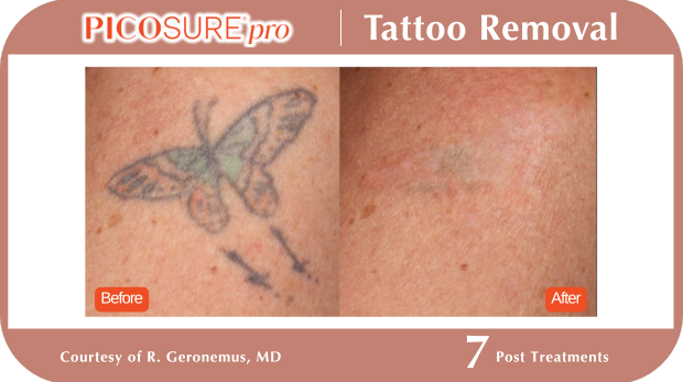 PicoSure Tattoo Removal PicoSure Tattoo Removal
