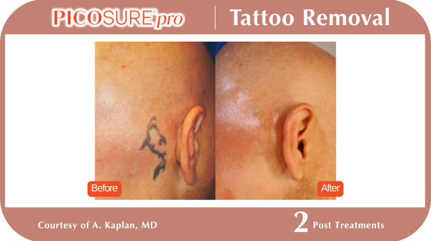 PicoSure Tattoo Removal PicoSure Tattoo Removal